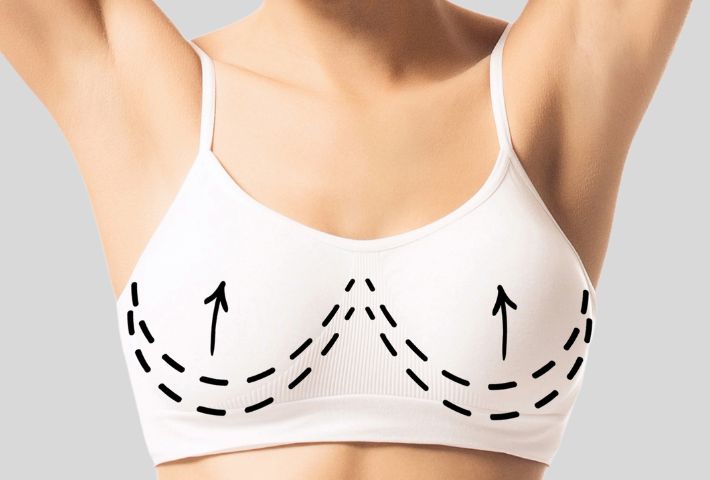 Élément de menu Lifting mammaire